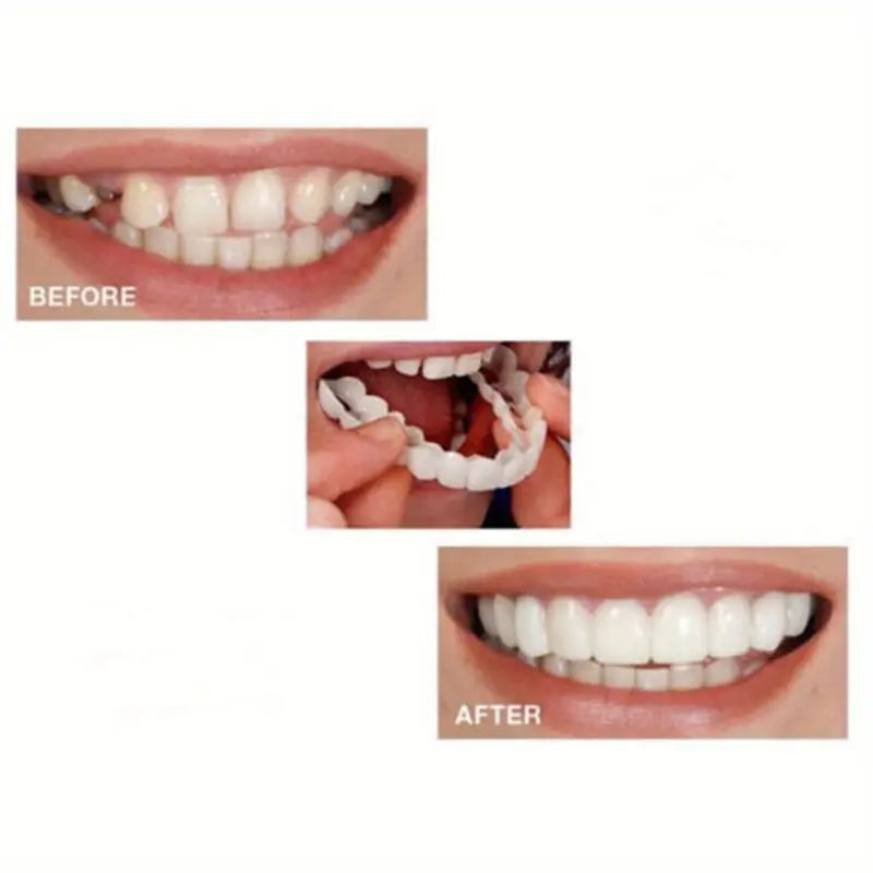 1 Pair (2 Pieces ) Realistic Dental Veneers – Upper & Lower Teeth, Snap on Smile